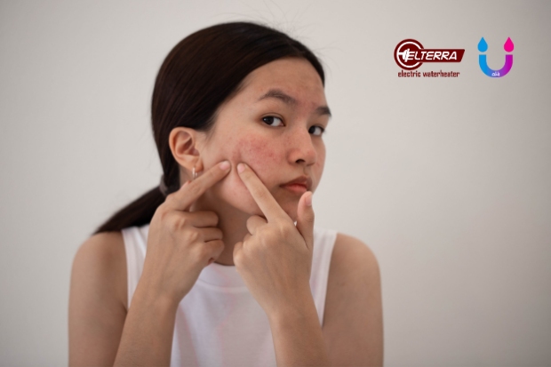 uap air panas untuk jerawat